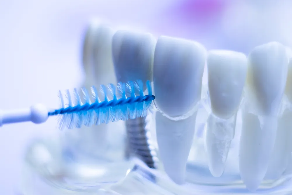 I vantaggi degli spazzolini interdentali per i denti